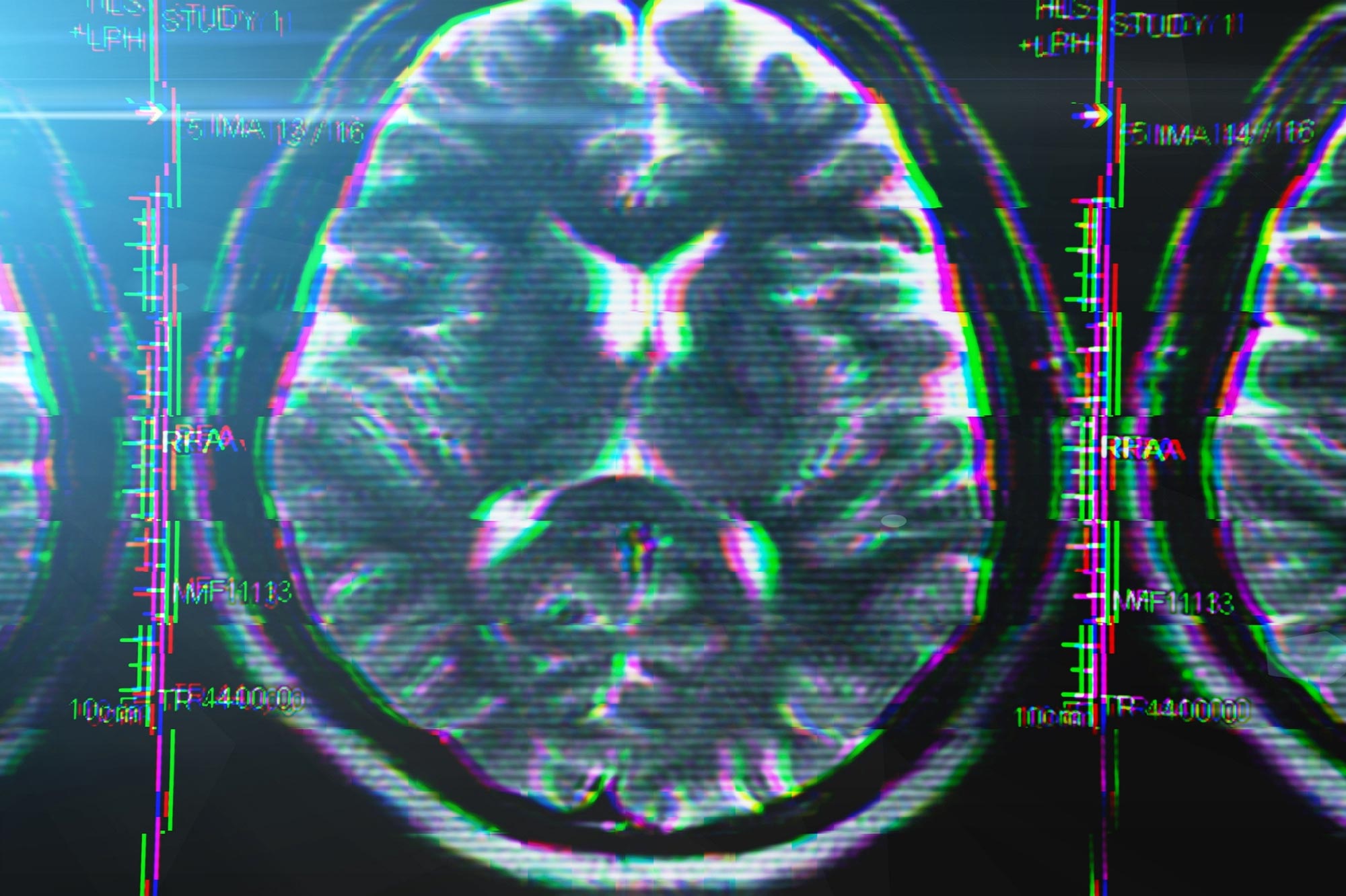 Brain Glitch Stress Disorder Concept